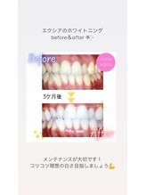 セルフホワイトニングサロン　エクシアホワイトニング宇治小倉店/ビフォーアフター