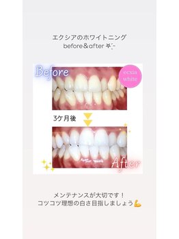 セルフホワイトニングサロン　エクシアホワイトニング宇治小倉店/ビフォーアフター