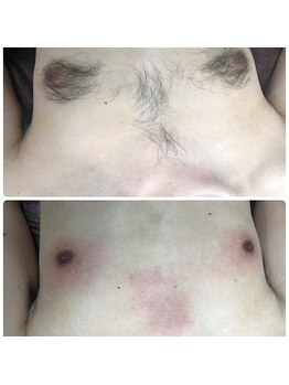 ハレノヒ(HaLeNoHi)/【ブラジリアンワックス】