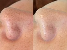 ビオエル 横浜店(Bioel)/【ハーブピーリング　横浜】