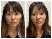 ペリドット(Peridot)/最新レッドショット×目元マシン