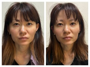 ペリドット(Peridot)/最新レッドショット×目元マシン