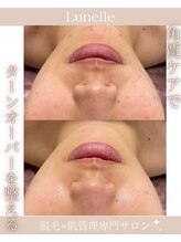 ルネル(Lunelle)/一度リセット！美肌への分岐点！