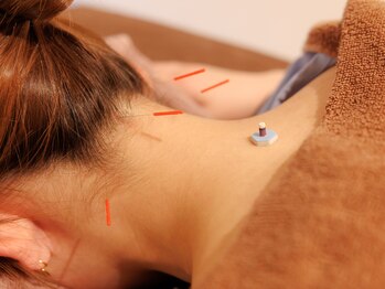 Anela鍼灸整体院の写真/マッサージでは届かないコリを【鍼ならでは】の技術でアプローチ！プロの施術で不調を改善◎一度お試しを★