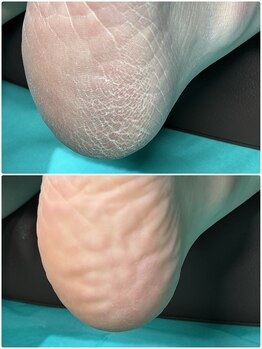 ディオフット(DIO FOOT)の写真/【国内トップクラスの施術実績】経験豊富な知識と確かな技術力で[巻き爪/分厚い爪]も改善◎