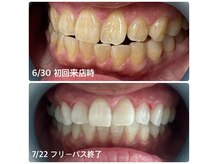 ホワイトニングショップ 福島店(WHITENINGSHOP)の雰囲気（お客様ビフォーアフター♪長年の着色汚れも真っ白！）