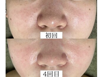 サロンドジェシカ(salon de Jessica)/ハーブピーリング