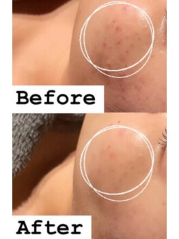 煌(kirameki)/ニキビケア・改善コース