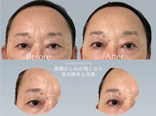 バウムユー 銀座店(baum.u)/無重力リフトBefore After