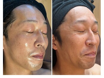 フェイスプラスリフ(FACE+RiF)/しわ改善、たるみ改善