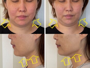 ディオーネ 西船橋駅前店(Dione)/レモンボトル◇Before After