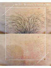 Sua BEAUTYSTUDIO【シュガーリング脱毛/光脱毛/REVI/フェイシャル/ハーブピーリング】/- シュガーリング脱毛 -