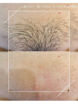 Sua BEAUTYSTUDIO【シュガーリング脱毛/光脱毛/REVI/フェイシャル/ハーブピーリング】/- シュガーリング脱毛 -