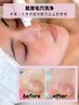 限定【イベント前肌管理】毛穴悩み・肌のくすみにお悩みの方￥12,000→￥8500