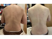 セレンディピティ(Serendipity)/ブライダルエステ★背中痩せ