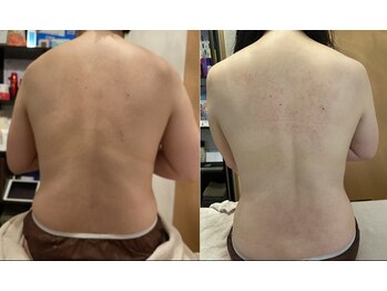 セレンディピティ(Serendipity)/ブライダルエステ★背中痩せ