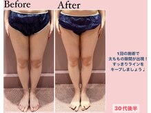 じぶんdeエステ 梅田店/CELLZERO.式　症例/太もも/1回