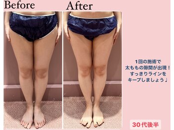 じぶんdeエステ 梅田店/CELLZERO.式 症例/太もも/1回