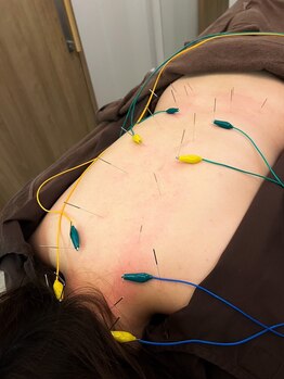 ハリマジック 代官山(HARI MAGIC)/【代官山/鍼灸/美容鍼】