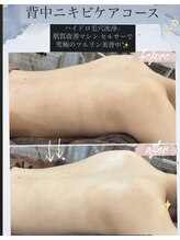 エステティックサロン ベルエトワール住吉店/背中ニキビケア