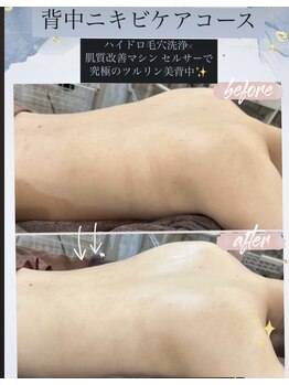 エステティックサロン ベルエトワール住吉店/背中ニキビケア