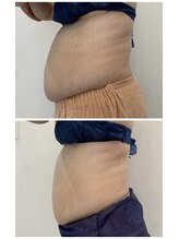 レミュ(Remu)/横からの変化が凄い！！