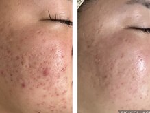 アンドカリス(Charis)/プラズマニキビbefore→after