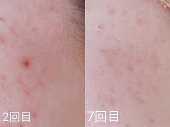 ウィハナ(wehana)/【ハーブピーリング】赤み/毛穴