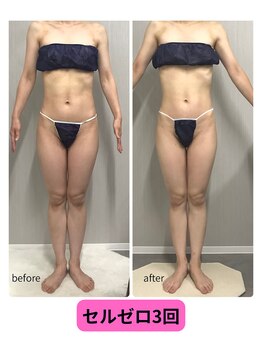 アーク(ARC)/全身痩身120分ビフォーアフター