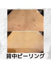 チェンジ(Change)/背中ピーリング