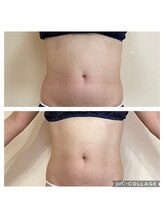 アクアモア/アクアモアの痩身★BeforeAfter