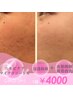 【ニキビケアマイクロニードル60分】強力殺菌&皮脂抑制 ¥5000→¥4,000