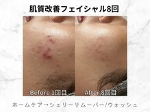リライン(ReLine)/【リアボーテフェイシャル8回】