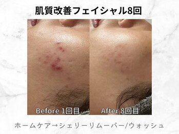 リライン(ReLine)/【リアボーテフェイシャル8回】
