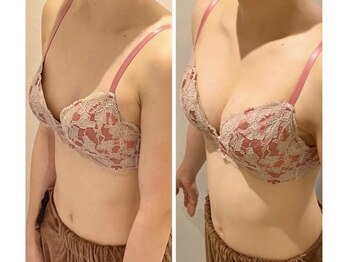 リール 恵比寿店(RIRE)/バストアップ症例【広尾恵比寿】