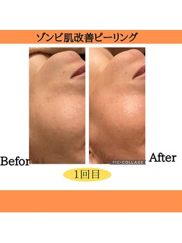 パルティノ 高崎店/ピーリング・剥離なし