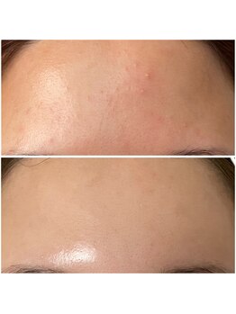 ユウビ ビューティー サロン(Yuubi)/【peel stage】ハーブピーリング