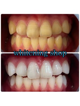 ホワイトニングショップ 山形店(Whiteningshop)/回数券で効果実感