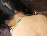 【眼精疲労/睡眠改善】美容鍼60分¥6000