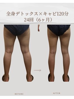 アメリオ(Amelio)/全身デトックス+キャビ120分