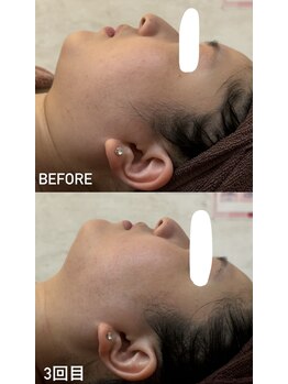 デュールイースト(Duul East)/小顔コルギ