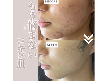 リラクゼーションサロン ラキ(laki)/トロイアルケ【ニキビ・小顔】