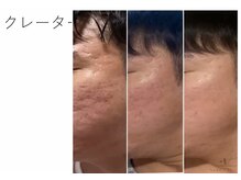 Mirai【毛穴/ハーブピーリング/エイジングケア/頭皮ケア】【3/1 NEW OPEN (予定)】/凸凹肌◎オーダーメイドハーブ