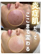 ウニカ(Unica)/プラズマ毛穴・ニキビ改善２回目