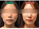 やなけん 亀戸店の写真/鏡や電車の窓に映る「老け顔・たるみ顔」にハッとしたら！美容鍼+LEDでたるみの原因を改善し小顔へ