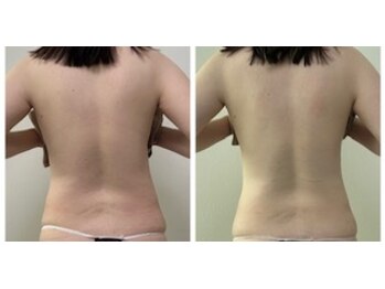 エクラニーク(Eclanique)の写真/期間限定！！サマーキャンペーン☆効果出しに自信あり！『今年の夏は隠さない』