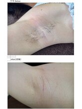 ヴィオール 名古屋栄店(VIOR)/【レディース脱毛】　脇　　