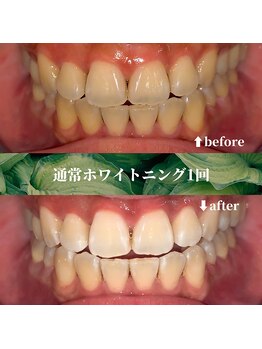 フタバ 天神大名店(futaba)/初回ホワイトニングbefore after