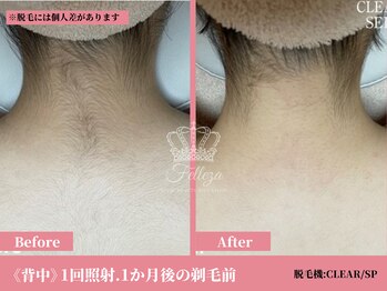 フェレザ 新潟(Felleza)/女性脱毛12