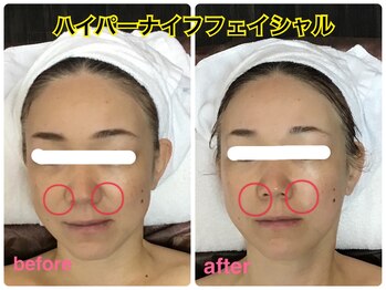 ラウレア 松山店(LAULEA)/ハイパーナイフフェイシャル